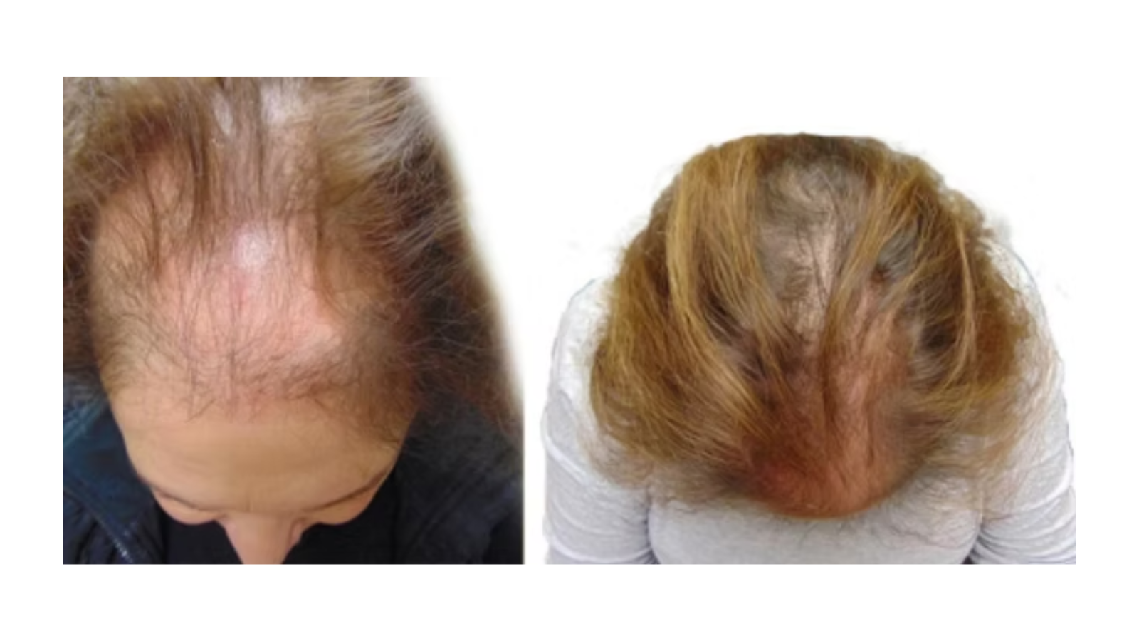 Treatment of Alopecia